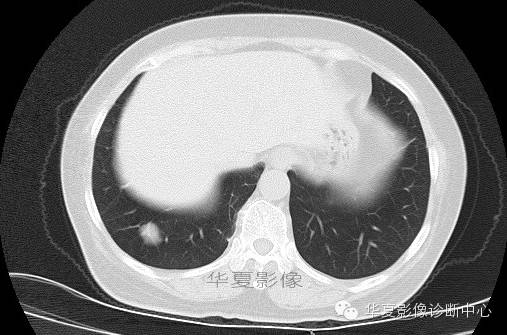 【病例学习】肺错构瘤一例