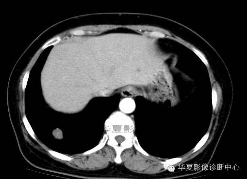 【病例学习】肺错构瘤一例
