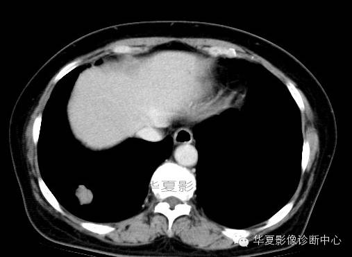 【病例学习】肺错构瘤一例