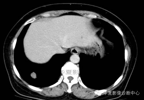 【病例学习】肺错构瘤一例