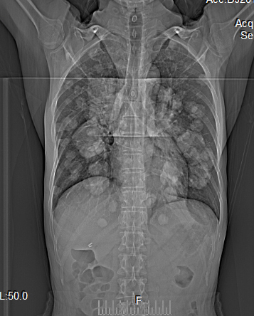 【病例】食管癌肺转移1例X线CT影像表现