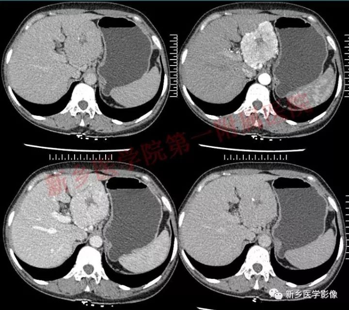 【病例】腹膜后巨淋巴结增生症1例CT影像表现