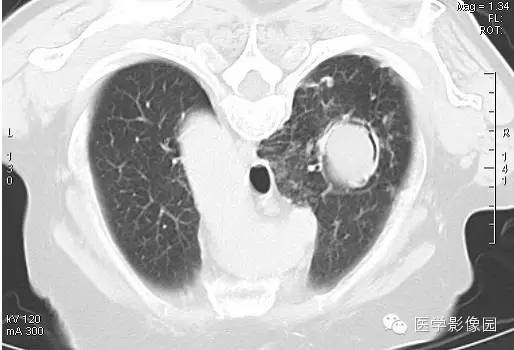 【病例】肺曲菌病1例CT影像表现