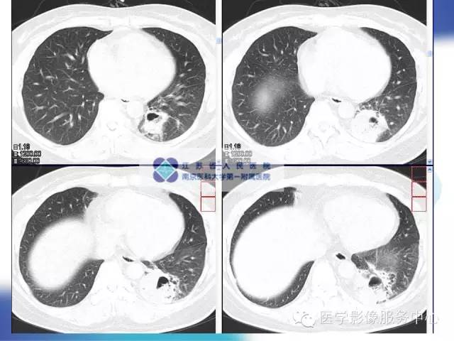 【病例】肺隔离症1例CT影像表现