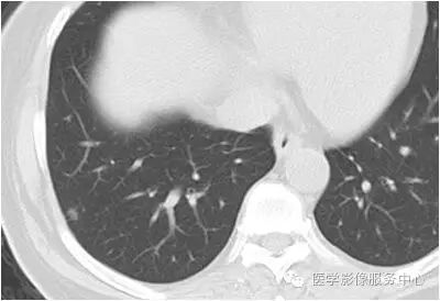【病例】肺内小结节，估计80%的同行都没考虑这个诊断