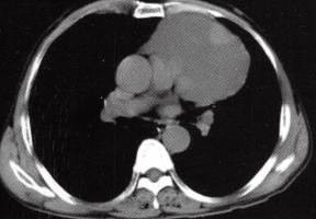 【病例】胸腺囊肿1例CT