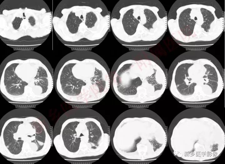 【病例】小细胞肺癌1例CT影像表现