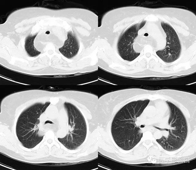 【病例】后纵隔脂肪瘤1例CT影像表现
