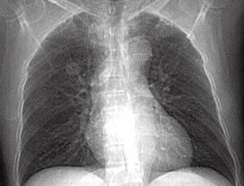 【病例】肺错构瘤1例CT影像表现