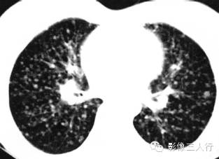 肺转移瘤的CT报告书写技巧与提示