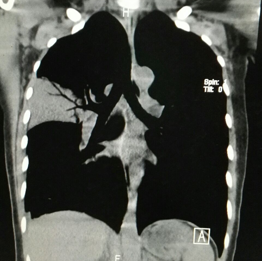 【病例】大叶性肺炎1例CT影像表现