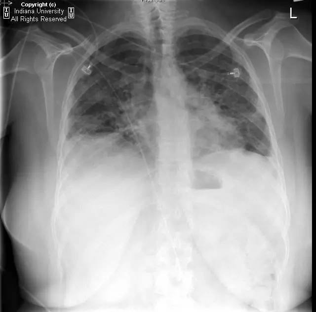 【病例】普通型间质性肺炎/特发性肺间质纤维化1例CT