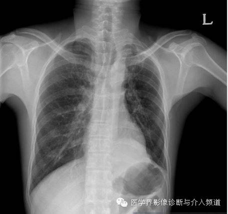 【病例】肺部纱布瘤1例CT影像表现