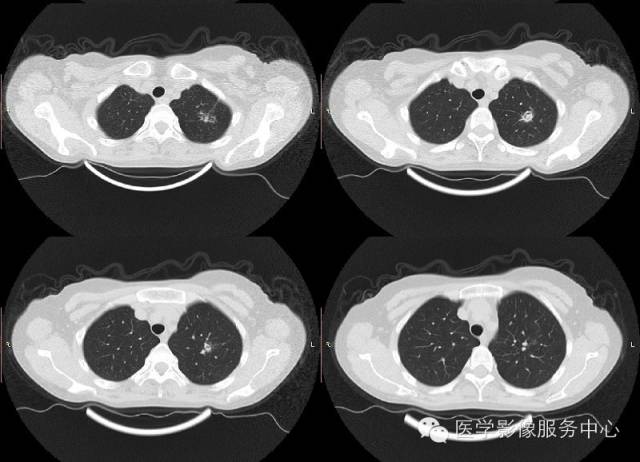 【病例】肺曲菌病1例CT影像表现