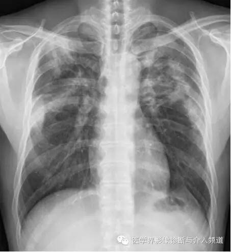 【病例】嗜酸粒细胞性肺炎1例X线CT影像表现
