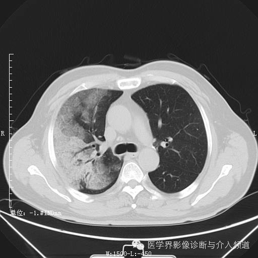 【病例】右肺上叶腺癌1例CT影像表现