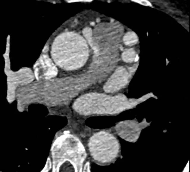 【病例】起源异常的冠状动脉1例CT影像表现