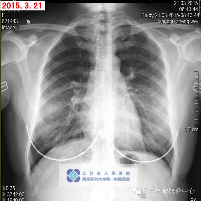 【病例】肺隐球菌病1例CT影像表现