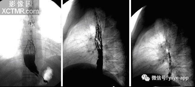 【病例】食管静脉曲张1例X线CT影像