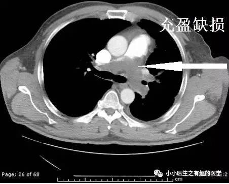 肺动脉充盈缺损不一定是血栓—学习被老外误诊误治的肺栓塞