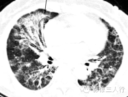 肺内粟粒状小结节的鉴别诊断