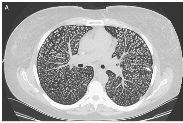 【病例】肺异物性肉芽肿1例CT影像表现