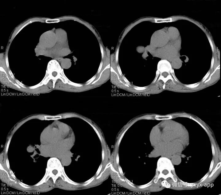 【病例】右肺中叶硬化性血管瘤1例CT