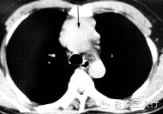 纵隔常见实性疾病的鉴别诊断