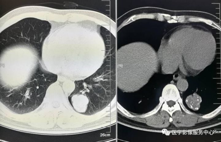 【病例】左肺下叶错构瘤1例CT