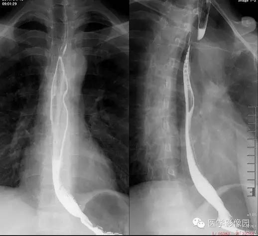 迷走右锁骨下动脉