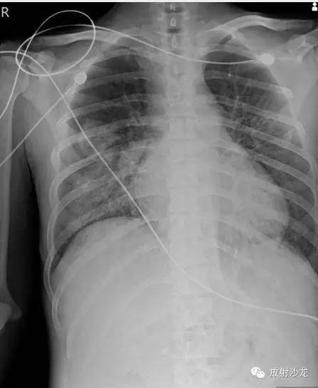 【病例】急性纤维素性机化性肺炎1例CT影像表现