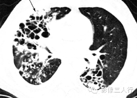 肺囊性病变的鉴别诊断