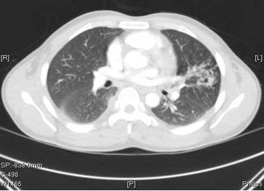 【病例】肺吸虫囊肿1例CT影像表现