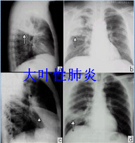 八种常见肺炎的X线诊断