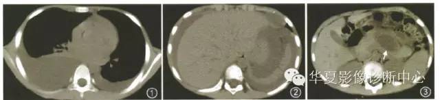 【病例】胰胸瘘2例影像表现