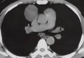 【病例】心包囊肿1例CT