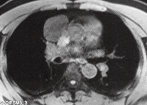 【病例】心包囊肿1例CT
