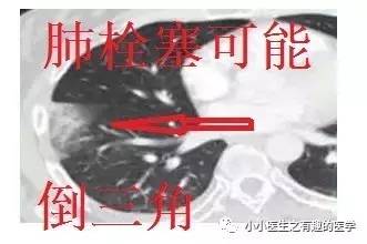 肺栓塞提高篇：CT平扫可发现、甚至诊断肺栓塞，看看国外高手论肺栓塞