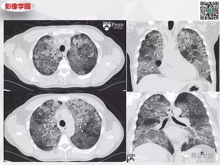 【双语病例】肺泡蛋白沉积症PAP一例CT 【双语病例】肺泡蛋白沉积症PAP一例CT
