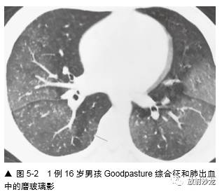HRCT:磨玻璃影的意义 HRCT:磨玻璃影的意义
