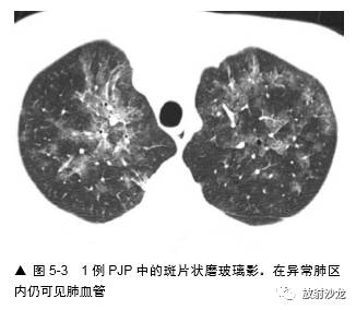 HRCT:磨玻璃影的意义 HRCT:磨玻璃影的意义
