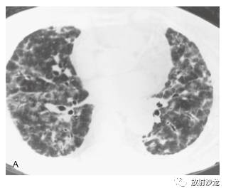 HRCT:磨玻璃影的意义 HRCT:磨玻璃影的意义