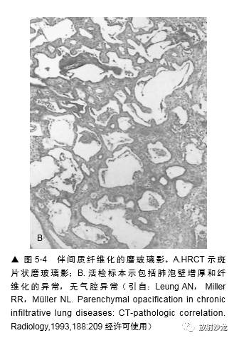 HRCT:磨玻璃影的意义 HRCT:磨玻璃影的意义