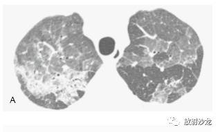 HRCT:磨玻璃影的意义 HRCT:磨玻璃影的意义