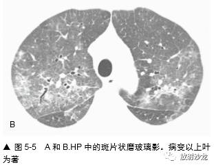 HRCT:磨玻璃影的意义 HRCT:磨玻璃影的意义