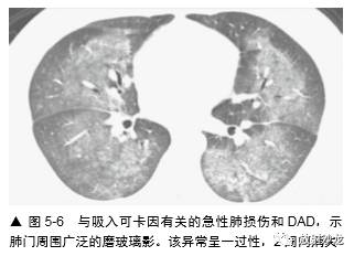 HRCT:磨玻璃影的意义 HRCT:磨玻璃影的意义