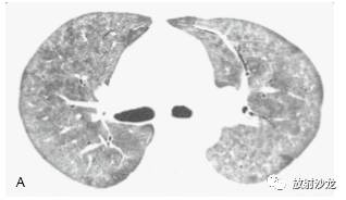HRCT:磨玻璃影的意义 HRCT:磨玻璃影的意义