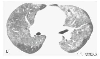HRCT:磨玻璃影的意义 HRCT:磨玻璃影的意义