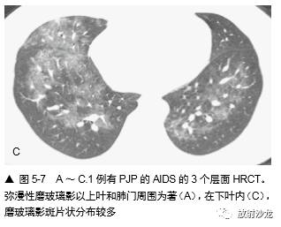 HRCT:磨玻璃影的意义 HRCT:磨玻璃影的意义