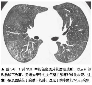 HRCT:磨玻璃影的意义 HRCT:磨玻璃影的意义
